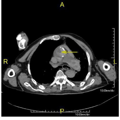 Axial Postmortem Ct Scan Showing Invagination Of Collapsed Ascending