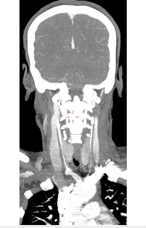 A Computed Tomography Angiography Of The Head And Neck Showing Severely