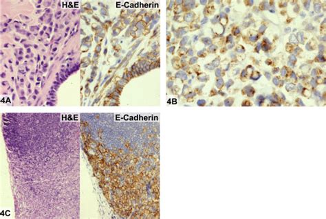 E Cadherin Reactivity In Invasive Lobular Carcinoma Case 4 A