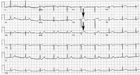 Emergency Department Electrocardiogram Demonstrating Sinus Bradycardia Download Scientific