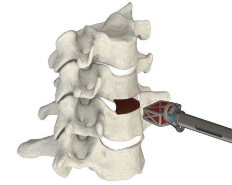 Cervical Spine Truss System Integrated Plate Web Medical