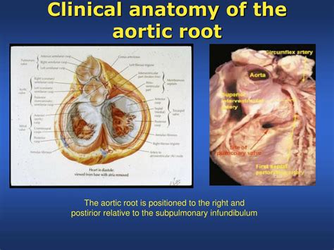 PPT - Aortic Regurgitation and Aortic Leaflet Repair PowerPoint ...