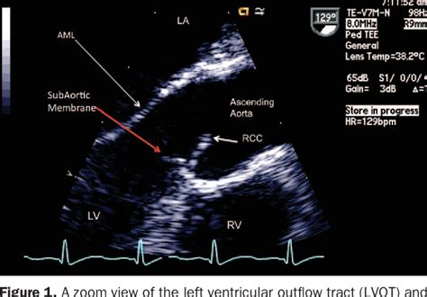 Figure From Discrete Subvalvular Aortic Stenosis Semantic Scholar