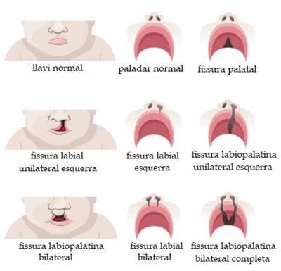 Patologia I Tractament De La Fissura De Llavi I O Paladar