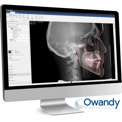 Owandy To Showcase Ai Ceph Analysis Tool Orthodontic Products