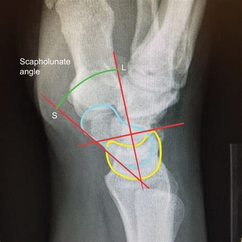 Full Article Optimal Management Of Scapholunate Ligament Injuries