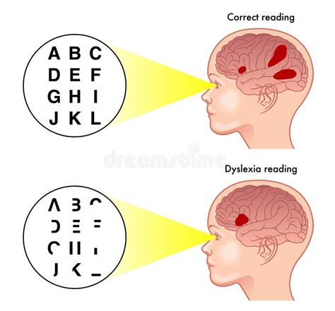 Dislexia Ilustración Del Vector Ilustración De Médico 29211473