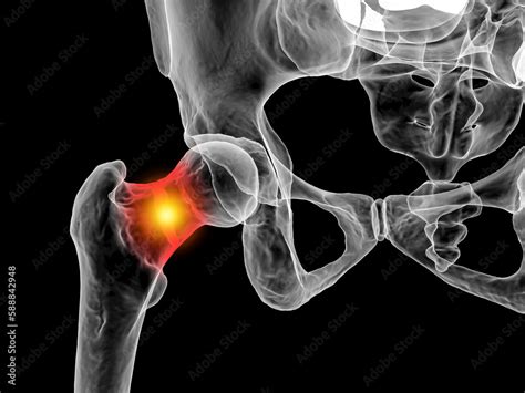 A fracture of the femur neck, a common type of hip fracture that ...