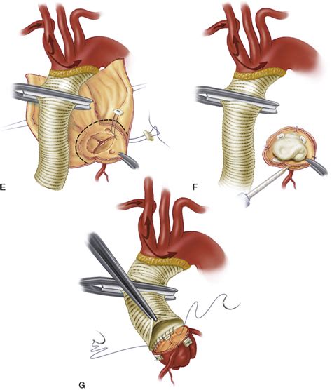 Surgical Therapy for Aortic Dissection | Thoracic Key