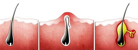 Foliculite Na Barba Saiba Como Tratar E Se Livrar Dela Co Flickr