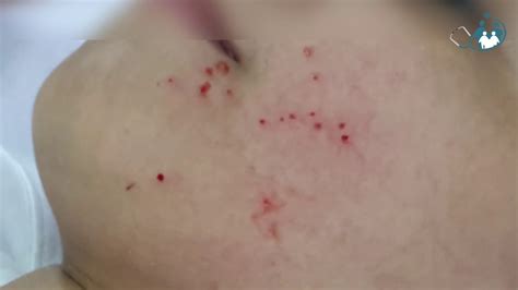 Molusco Contagioso Ep 01 Curetagem Em Paciente De 11 Anos Youtube