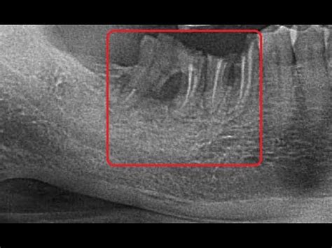 Failed Root Canal Treated Molars Extraction In Chennai Youtube