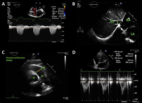 Echocardiographic Estimation Of Mean Pulmonary Artery Pressure A