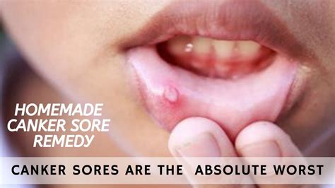 Homemade Canker Sore Remedy Canker Sores Are The Absolute Worst Youtube