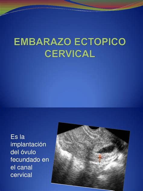 Embarazo Ectopico Cervical 1