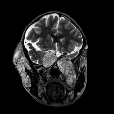 Plexiform Neurofibroma Image Radiopaedia Org