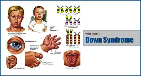 Down Syndrome It Is A Genetic Disorder Of Humans 2024