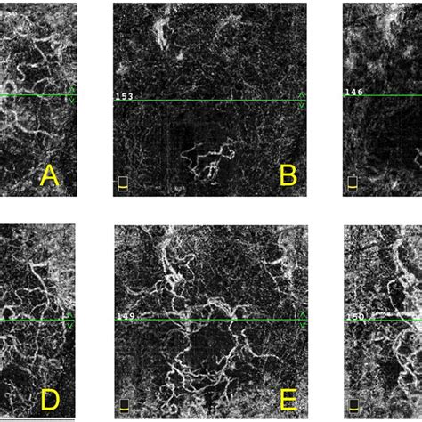 Octa En Face Images Of A Year Old Female Patient With Nvamd In Right