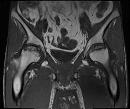 Avascular Necrosis Of Femoral Head Image Radiopaedia Org