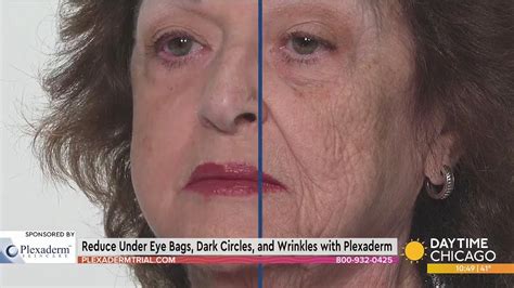 Reduce Under Eye Bags, Dark Circles, and Wrinkles with Plexaderm - YouTube