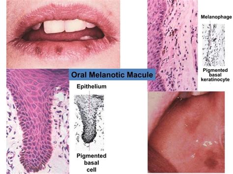 Precancerous Lesions In Oral Cavity