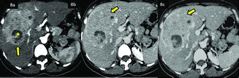 Triple Phase Cect Scan Of A Lesion In The Liver Suggestive Of Hcc On Download Scientific