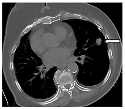 Ct Scan Of Chest Showing Right Lung Nodule Arrow On Left Panel And Images