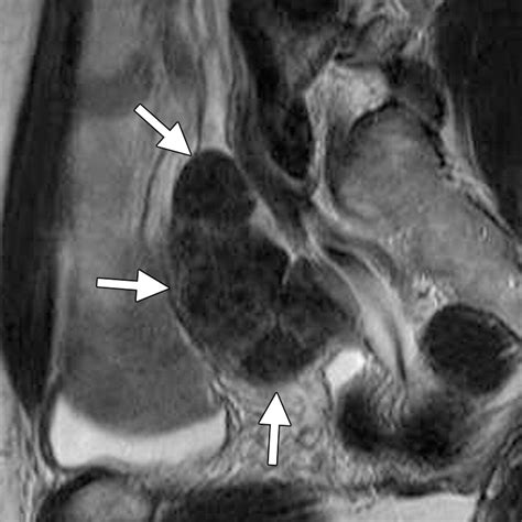 Uncommon Primary Pelvic Retroperitoneal Masses In Adults A Pattern