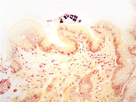 Sarcina Organisms In The Gastrointestinal Tract A Clinicopathologic