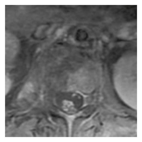 MRI image of liver hemangioma. (a) DE-MRI showing angiography of... | Download Scientific Diagram