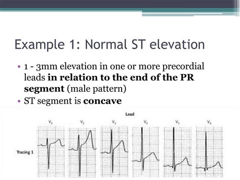 Ppt St Elevation Powerpoint Presentation Free Download Id3211680