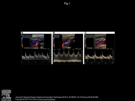 Rapid Progression Of Carotid Artery Atherosclerosis And Stenosis In A