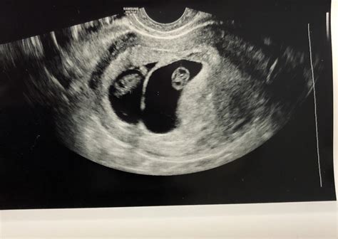 9 Week Ultrasound Twins