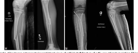 Pediatric Tibial Shaft Fractures Semantic Scholar Hot Sex Picture