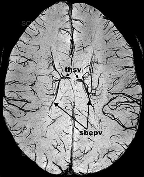 Photograph | Brain, MRI | Science Source Images