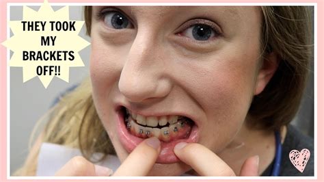 9 Month Braces Update They Took Off My Brackets 😮😮😮 Youtube