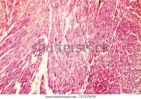 Heart Hypertrophy Photomicrograph Showing Hypertrophic Myocardium Stock