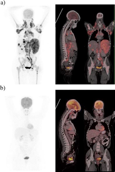 A B Whole Body Fdg Petct Maximum Intensity Projection Images