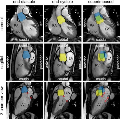 Cardiac Magnetic Resonance Images To Illustrate The Position Of The