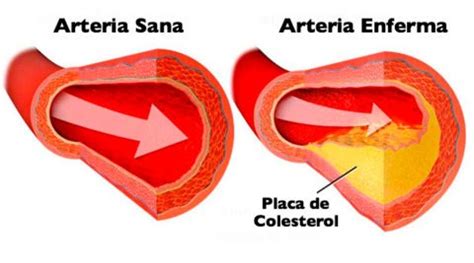 Aterosclerosis Dr Lucien Chassin Trubert Cirugía Vascular