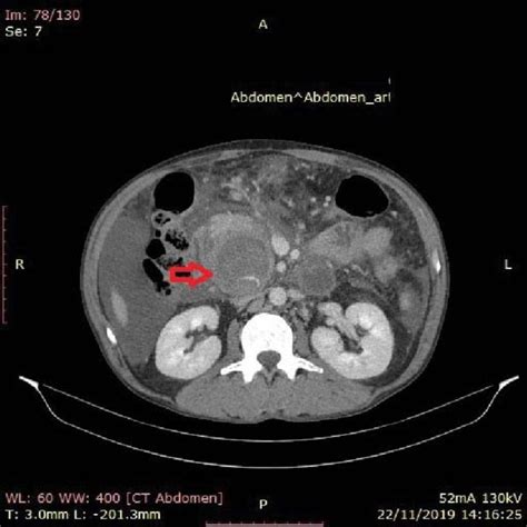 CT Scan Performed At Colentina Hospital Showing The Pseudoaneurysm Red