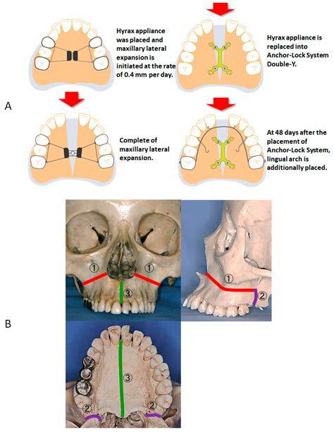 Jcm Free Full Text Severe Maxillary Protrusion Treated With