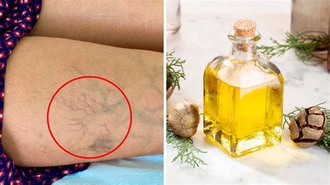 How To Get Rid Of Varicose Veins With Essential Oils YouTube