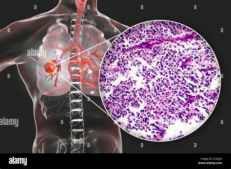 Cáncer de pulmón Ilustración por computadora y micrográfico ligero del