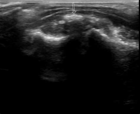 Synovial Chondromatosis Hand Image Radiopaedia Org