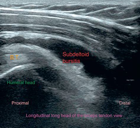 Subdeltoid Bursa Injection Clinical Tree