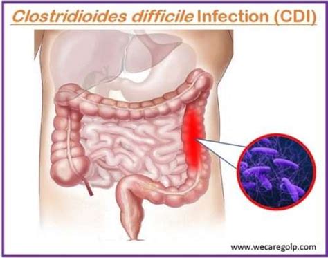 Clostridioides difficile Infection - We Care