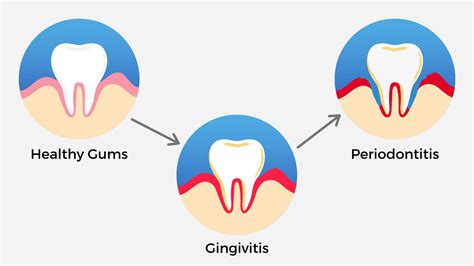 Periodontitis Gum Disease And How To Treat It