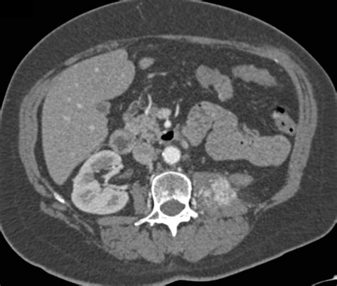 Recurrent Renal Cell Carcinoma With Metastases To Left Psoas Muscle And