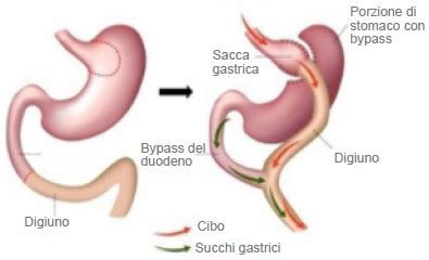 Chirurgia Per Dimagrire Bendaggio Gastrico